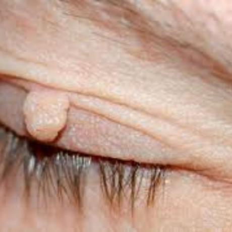 How to Remove a Skin Tag from Eyelid: Expert Treatment Process